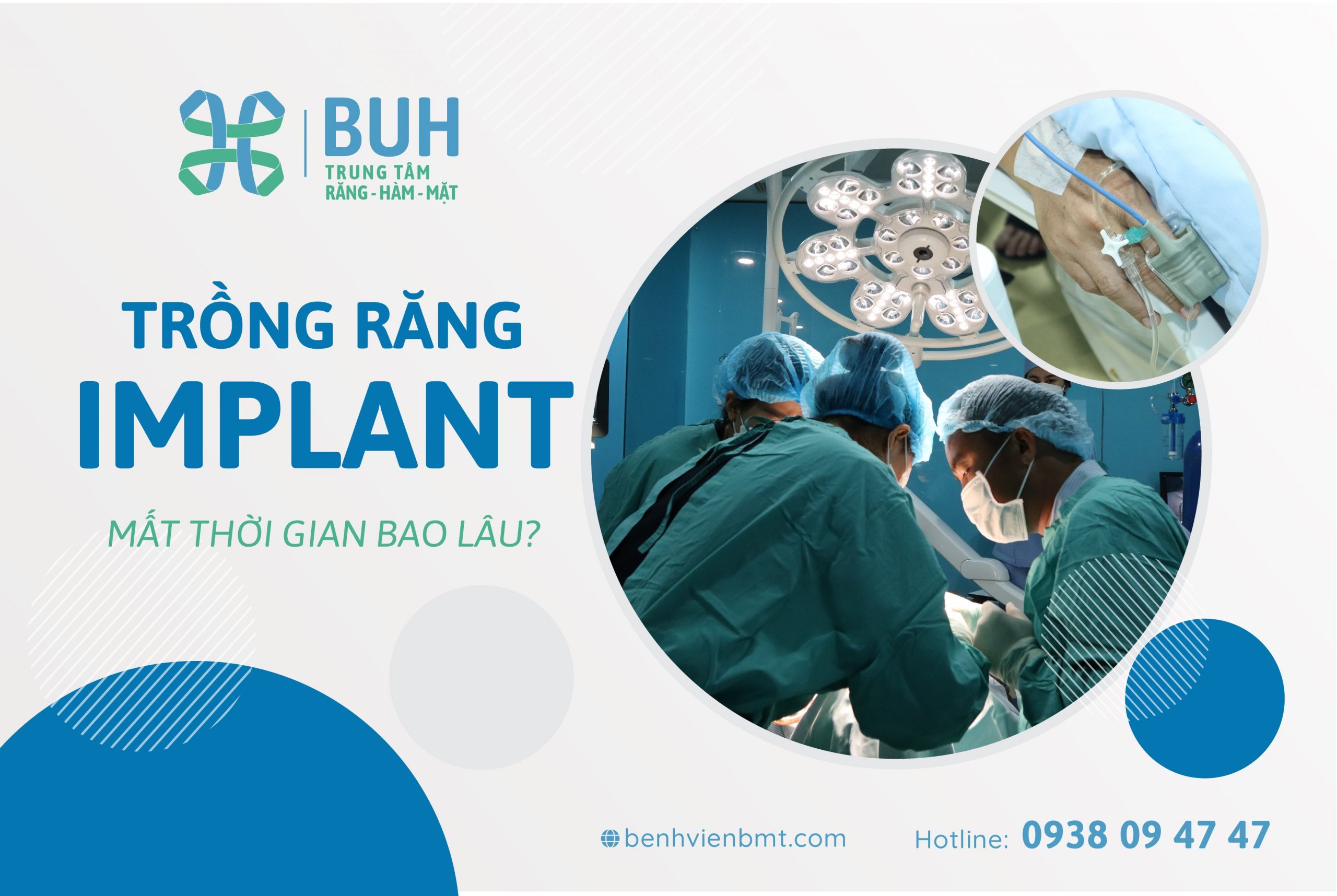 Bảng giá trồng răng implant - Chi phí cần biết 2024