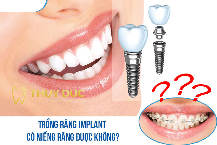 Bảng giá trồng răng implant - Chi phí cần biết 2024