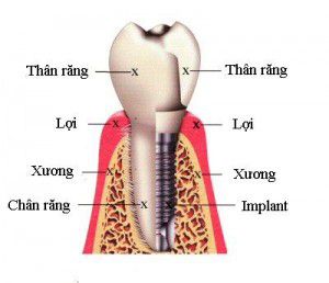 Implant là gì? Cấy ghép và ứng dụng trong y tế Implant là gì? Cấy ghép và ứng dụng trong y tế