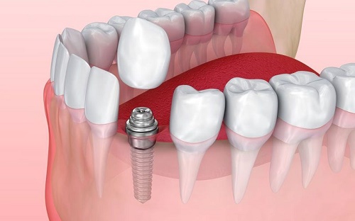 Implant là gì? Cấy ghép và ứng dụng trong y tế Implant là gì? Cấy ghép và ứng dụng trong y tế