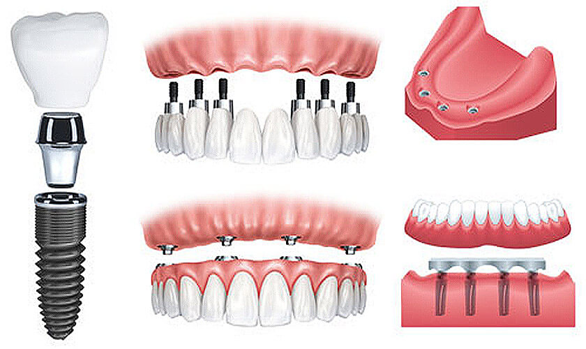 Implant là gì? Cấy ghép và ứng dụng trong y tế Implant là gì? Cấy ghép và ứng dụng trong y tế