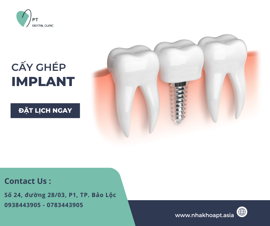 Implant là gì? Cấy ghép và ứng dụng trong y tế Implant là gì? Cấy ghép và ứng dụng trong y tế