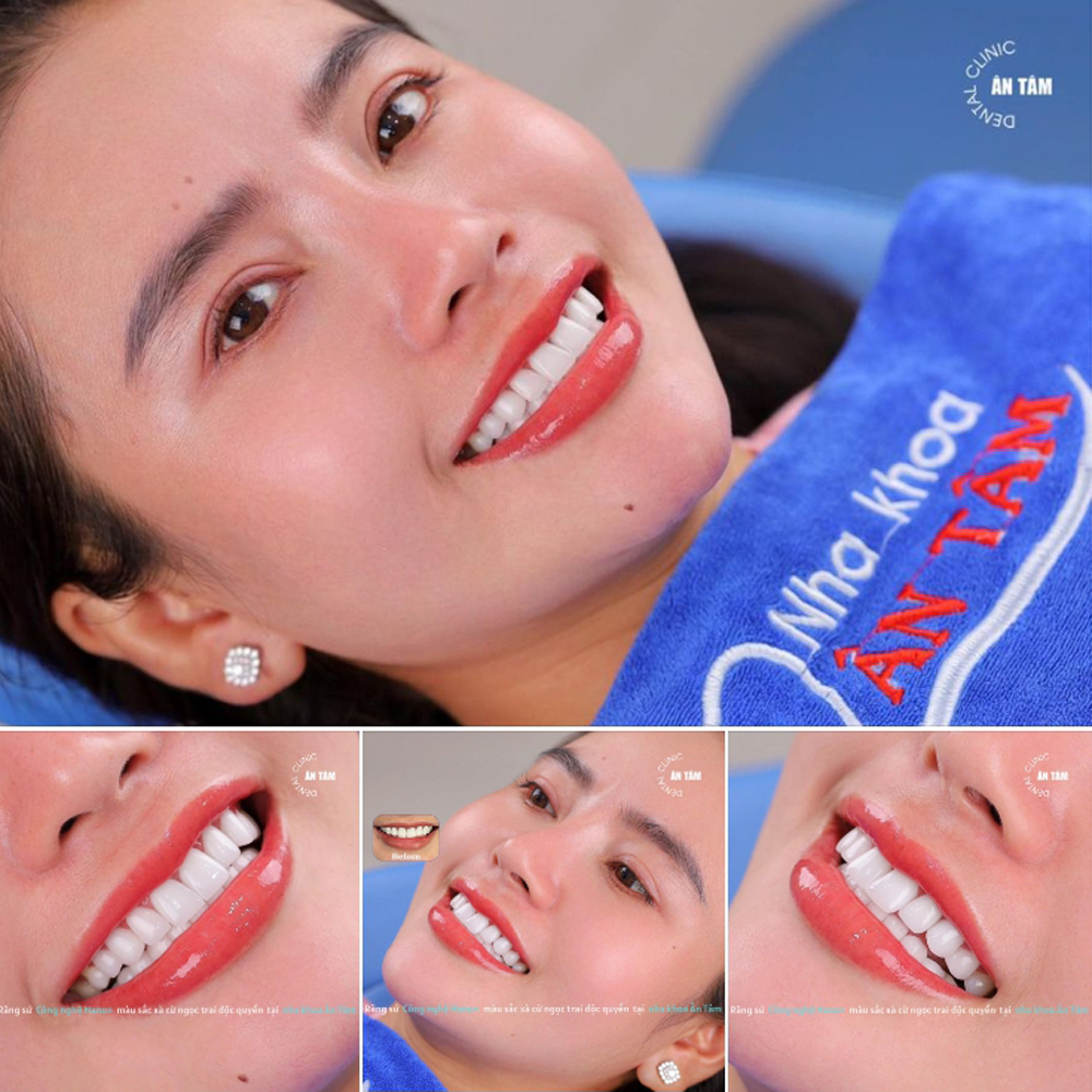 Làm Răng Sứ Hướng Dẫn Chi Tiết Từ A Đến Z