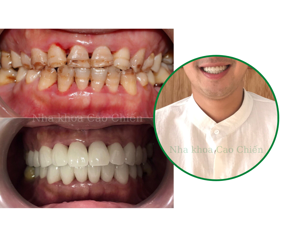 Làm Răng Sứ Hướng Dẫn Chi Tiết Từ A Đến Z