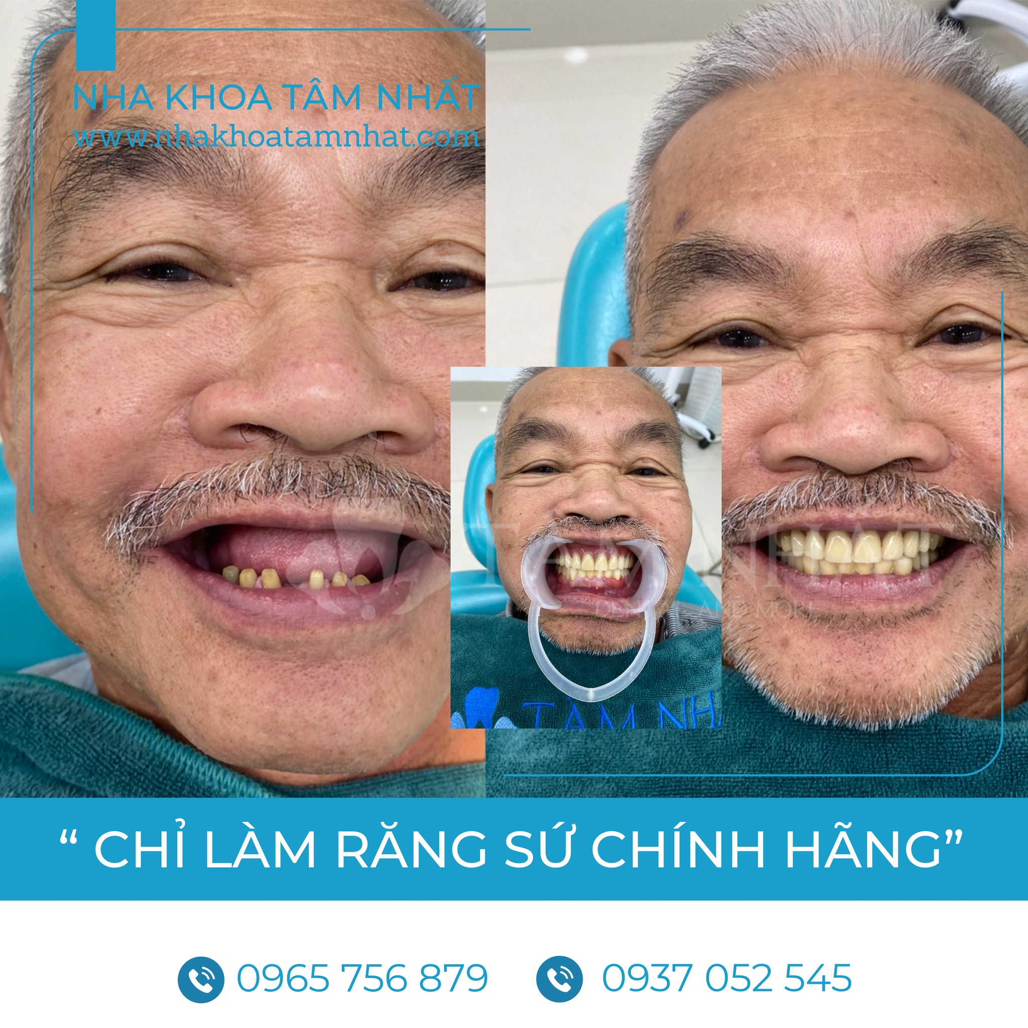 Làm Răng Sứ Hướng Dẫn Chi Tiết Từ A Đến Z