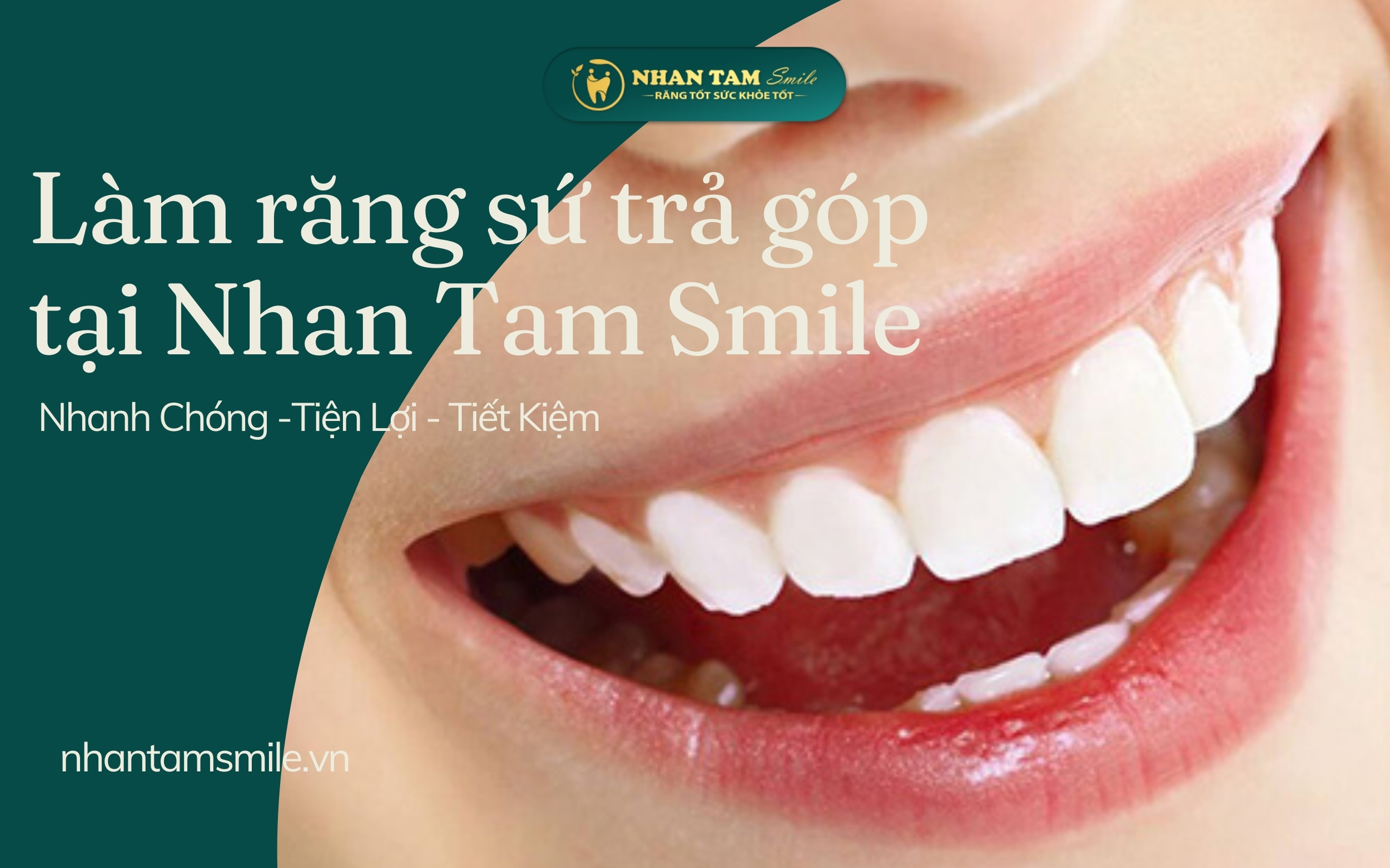 Làm Răng Sứ Hướng Dẫn Chi Tiết Từ A Đến Z