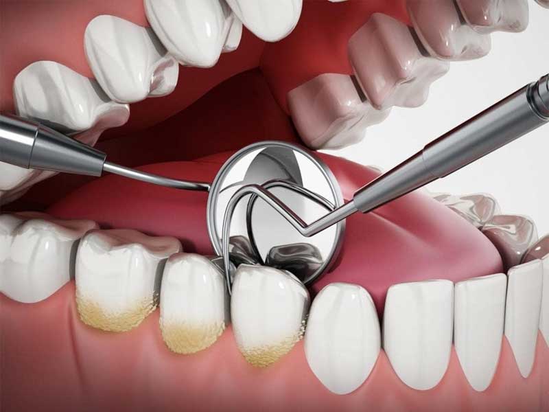 Lấy Vôi Răng Gần Đây: Nơi Uy Tín Chất Lượng năm 2024 Lấy Vôi Răng Gần Đây: Nơi Uy Tín Chất Lượng năm 2024