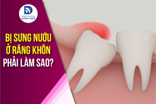 Răng Khôn Những Điều Cần Biết