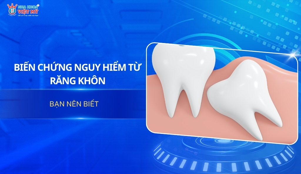 Răng Khôn Những Điều Cần Biết