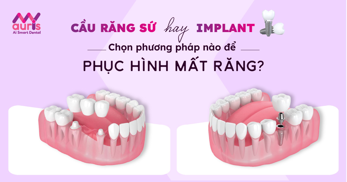 Răng sứ implant giá bao nhiêu? Bảng giá năm 2024 Răng sứ implant giá bao nhiêu? Bảng giá năm 2024