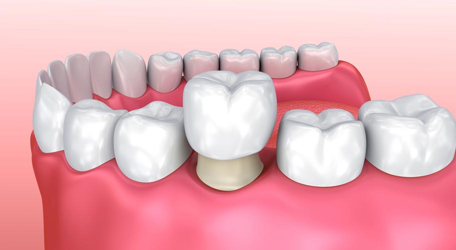 Răng sứ implant giá bao nhiêu? Bảng giá năm 2024 Răng sứ implant giá bao nhiêu? Bảng giá năm 2024