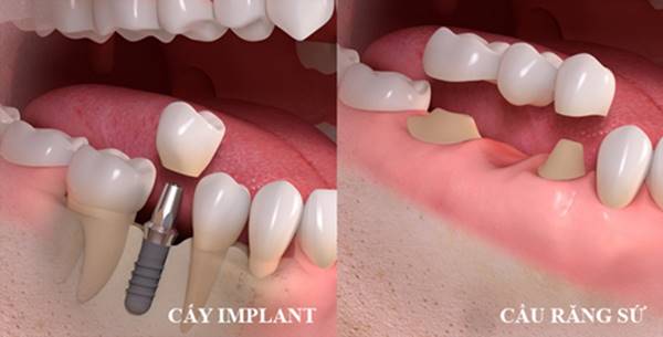 Răng sứ implant giá bao nhiêu? Bảng giá năm 2024 Răng sứ implant giá bao nhiêu? Bảng giá năm 2024
