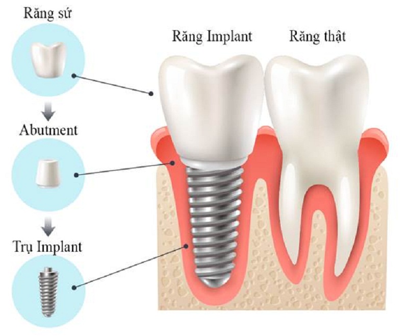 Răng sứ implant giá bao nhiêu? Bảng giá năm 2024 Răng sứ implant giá bao nhiêu? Bảng giá năm 2024
