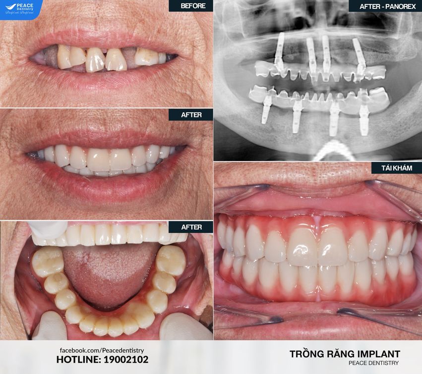 Trồng răng giá bao nhiêu? Giá mới nhất năm 2024