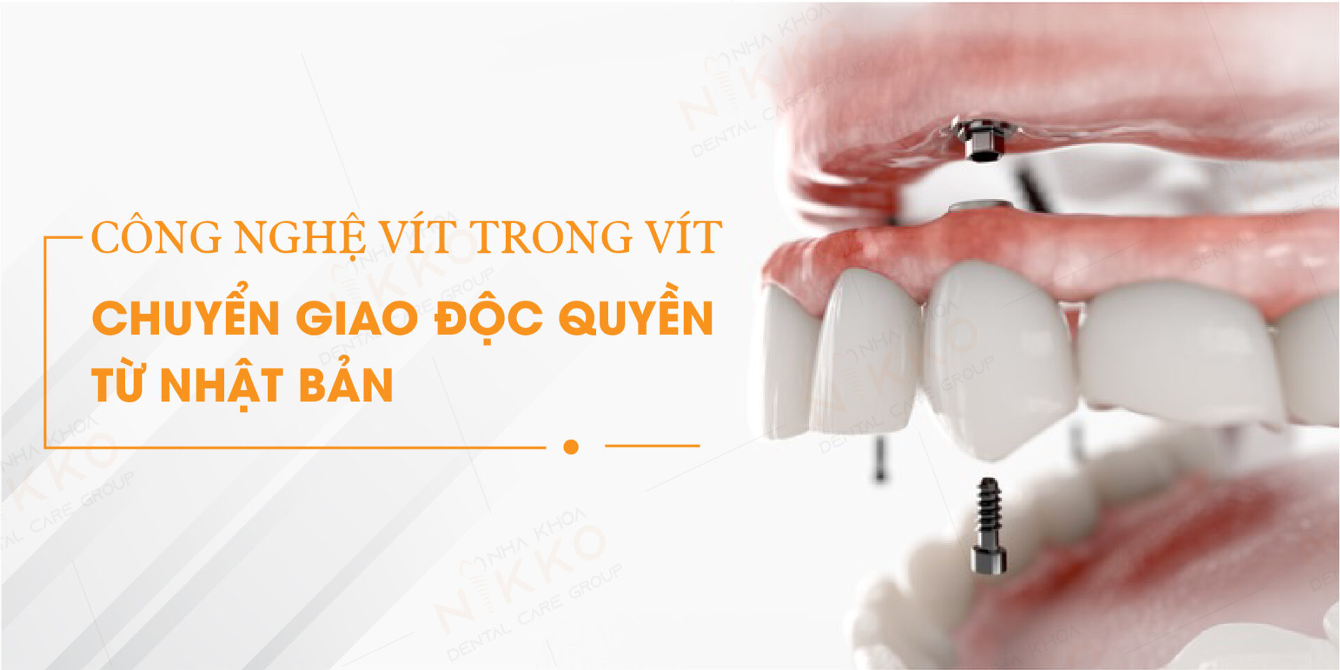 Trồng răng giá bao nhiêu? Giá mới nhất năm 2024