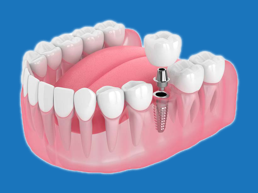 Trồng răng giá bao nhiêu? Giá mới nhất năm 2024