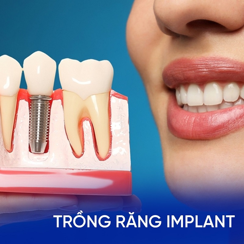 Trồng răng giá bao nhiêu? Giá mới nhất năm 2024