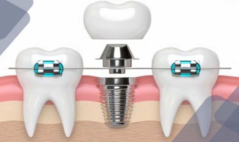 Trồng răng implant giá bao nhiêu trong năm 2024 Trồng răng implant giá bao nhiêu trong năm 2024