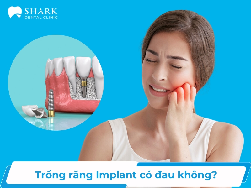 Trồng răng implant giá bao nhiêu trong năm 2024 Trồng răng implant giá bao nhiêu trong năm 2024