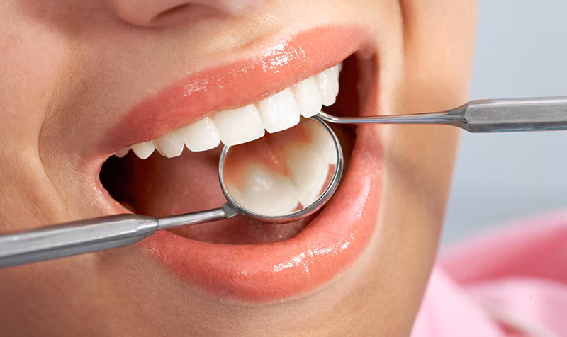 Tìm Hiểu Về Chi Phí Trám Răng Sâu Gần Đây