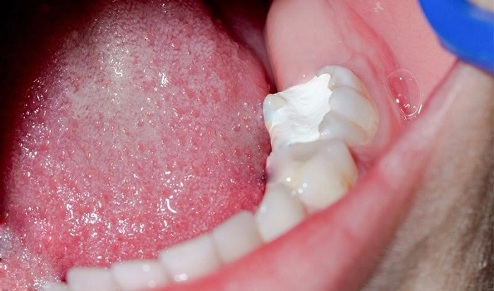 Trám Răng Thẩm Mỹ Thẩm Mỹ: Giải Pháp Nụ Cười Hoàn Hảo