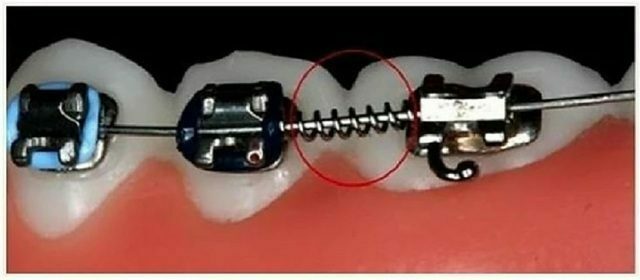 Chỉnh Nha Gần Đây - Những Xu Hướng Mới Và Phương Pháp Tiến Bộ