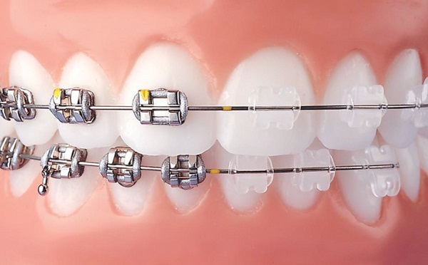Chỉnh Nha Gần Đây - Những Xu Hướng Mới Và Phương Pháp Tiến Bộ