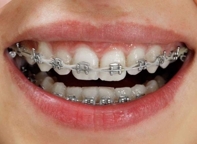 Dịch vụ chỉnh nha gần đây - Xu hướng làm đẹp và điều chỉnh nụ cười