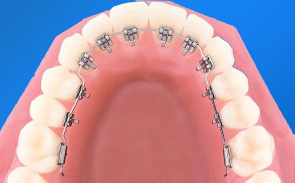Dịch vụ chỉnh nha gần đây - Xu hướng làm đẹp và điều chỉnh nụ cười