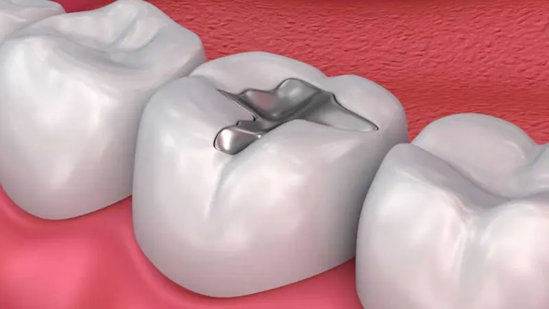 Dịch vụ hàn răng gần đây - Giải pháp chăm sóc sức khỏe răng miệng hiệu quả