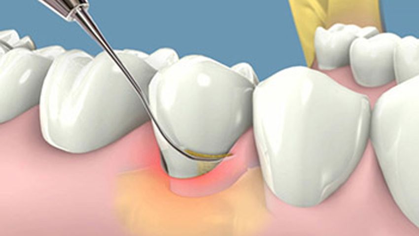 dịch vụ lấy cao răng điều trị nha chu gần đây