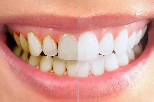 dịch vụ lấy cao răng điều trị nha chu gần đây