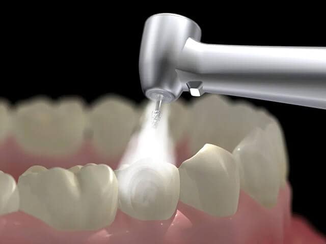 Hàn Răng Sâu Gần Đây - Bảo Vệ Nụ Cười Của Bạn