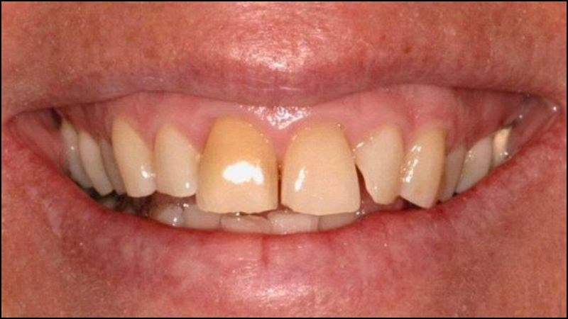 làm trắng răng gần đây làm trắng răng gần đây