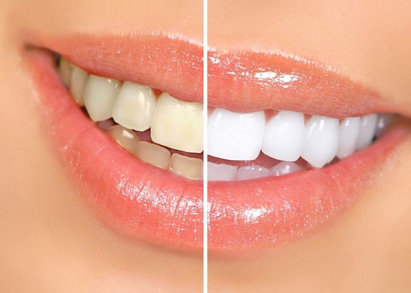 lấy cao răng gò vấp gần đây lấy cao răng gò vấp gần đây