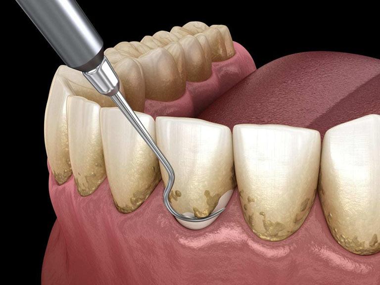 lấy cao răng gò vấp gần đây lấy cao răng gò vấp gần đây
