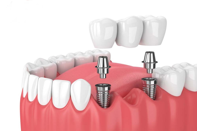Nha Khoa Trồng Răng Sài Gòn Gần Đây - Giải Pháp Hoàn Hảo Cho Nụ Cười Tươi Tắn