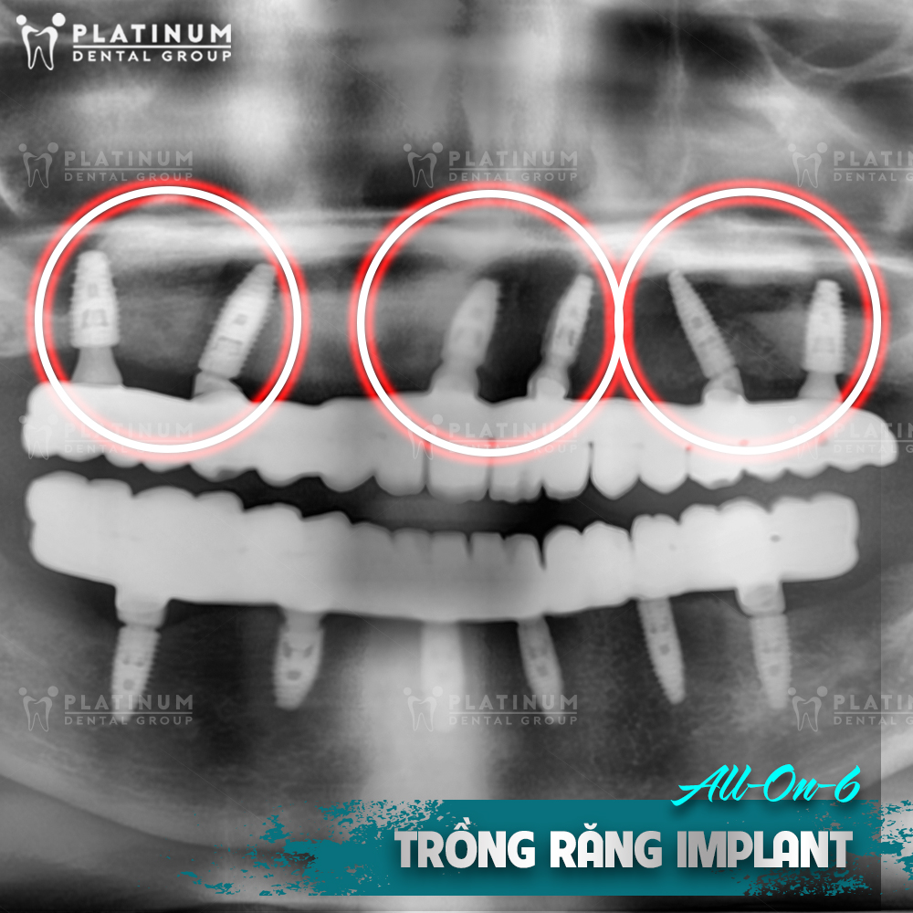 Phục Hình Răng Gần Đây - Những Xu Hướng Và Cách Chăm Sóc Để Có Nụ Cười Tươi Tắn