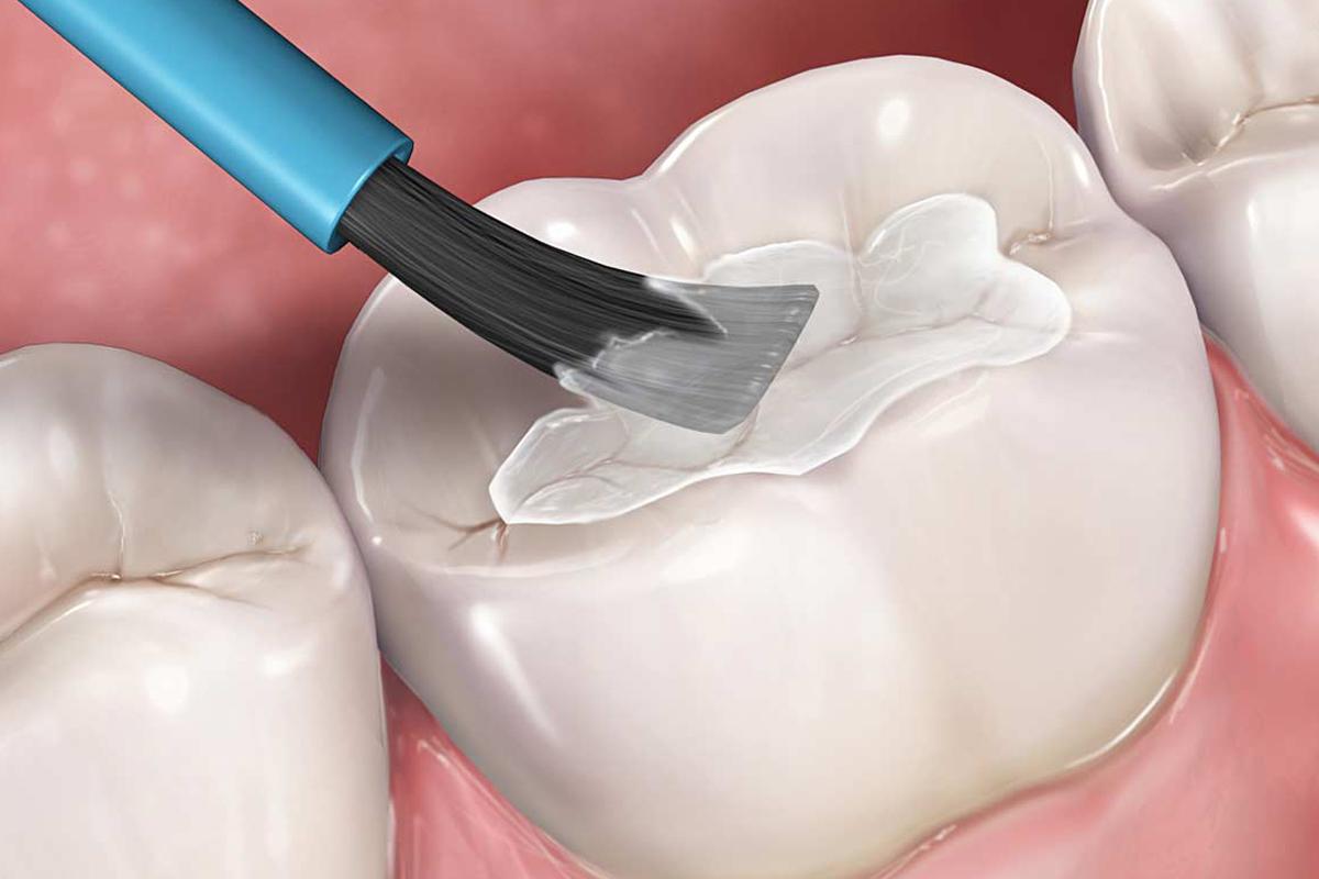 Trám Răng Cửa Gần Đây - Những Điều Cần Biết Để Có Nụ Cười Hoàn Hảo