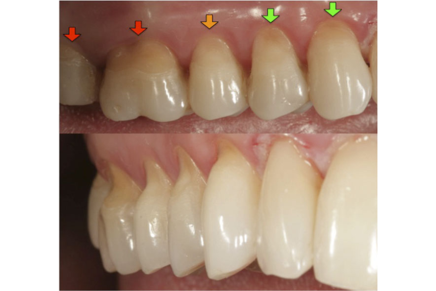Trám Răng Cửa Gần Đây - Những Điều Cần Biết Để Có Nụ Cười Hoàn Hảo