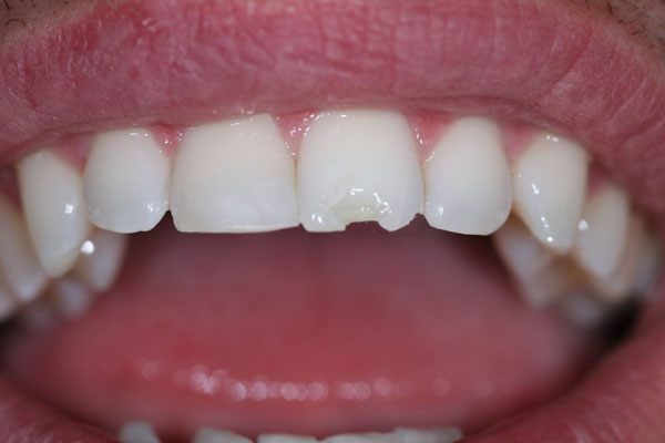 Trám Răng Cửa Gần Đây - Những Điều Cần Biết Để Có Nụ Cười Hoàn Hảo