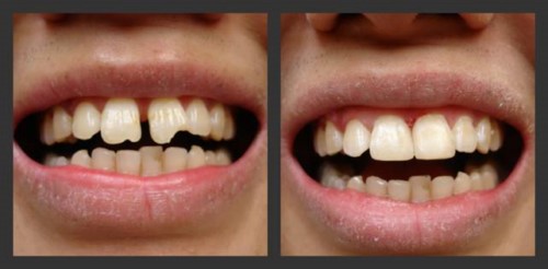 Trám răng thẩm mỹ gần đây: Xu hướng và lợi ích cho nụ cười của bạn
