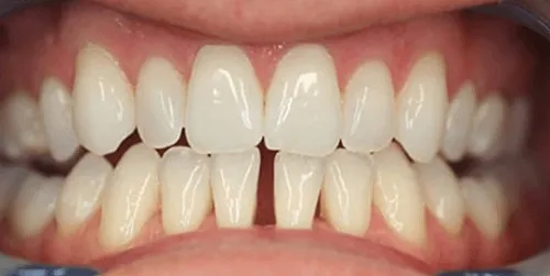 Trám Răng Thưa Gần Đây - Những Thông Tin Cần Thiết Để Khắc Ph phục Nụ Cười Của Bạn