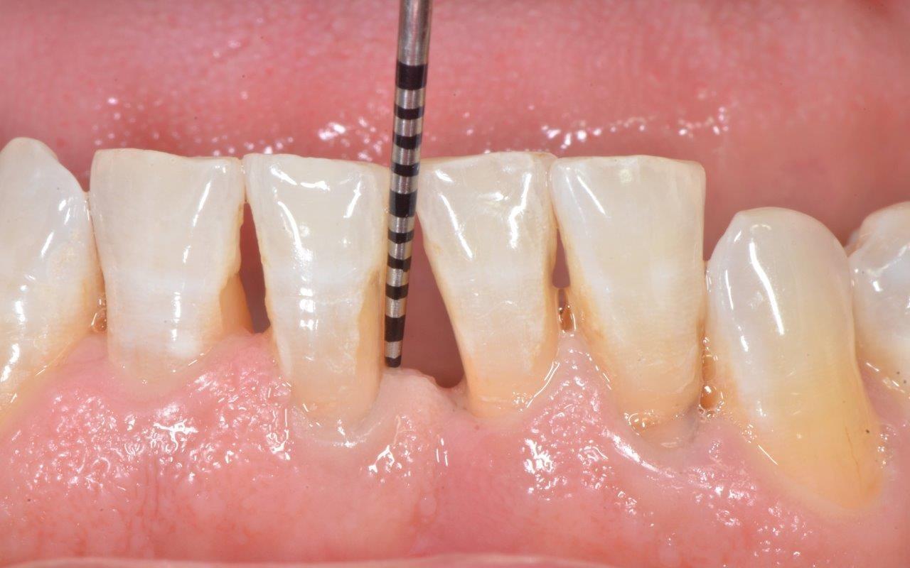 Trám Răng Thưa Gần Đây - Những Thông Tin Cần Thiết Để Khắc Ph phục Nụ Cười Của Bạn