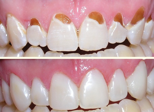 Trám Răng Thưa Gần Đây - Những Thông Tin Cần Thiết Để Khắc Ph phục Nụ Cười Của Bạn