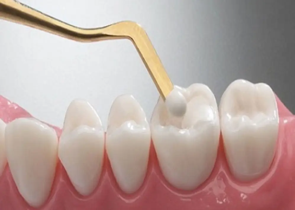 trám răng thẩm mỹ gần đây